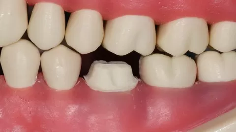 How to perform dental crowns that last and patients love